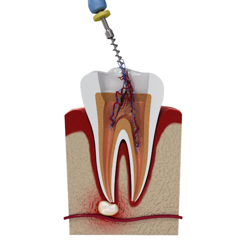 wortelkanaalbehandeling WaveOne Gold