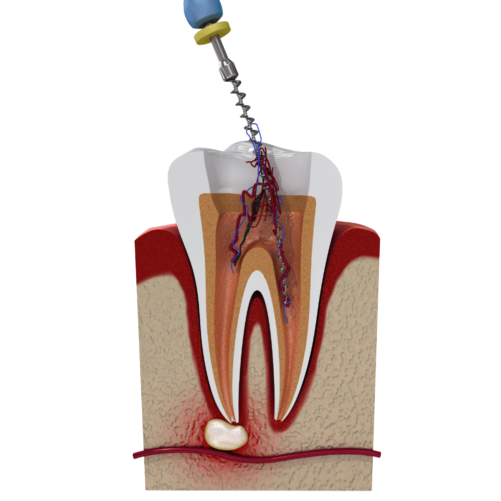 Tandwortelbehandeling met gereedschap