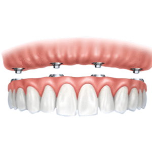 Tandprothese met bevestigingssystemen