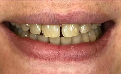 composiet Facings (3) Tanden met composiet facings zichtbaar