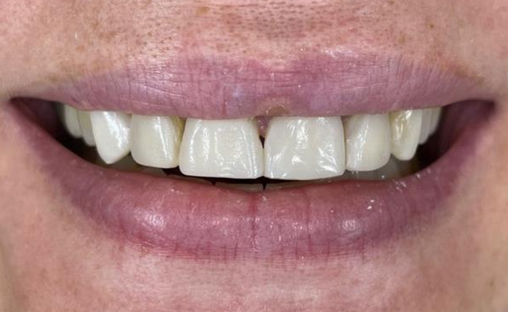 composiet Facings (4) Tanden met composiet facings zichtbaar