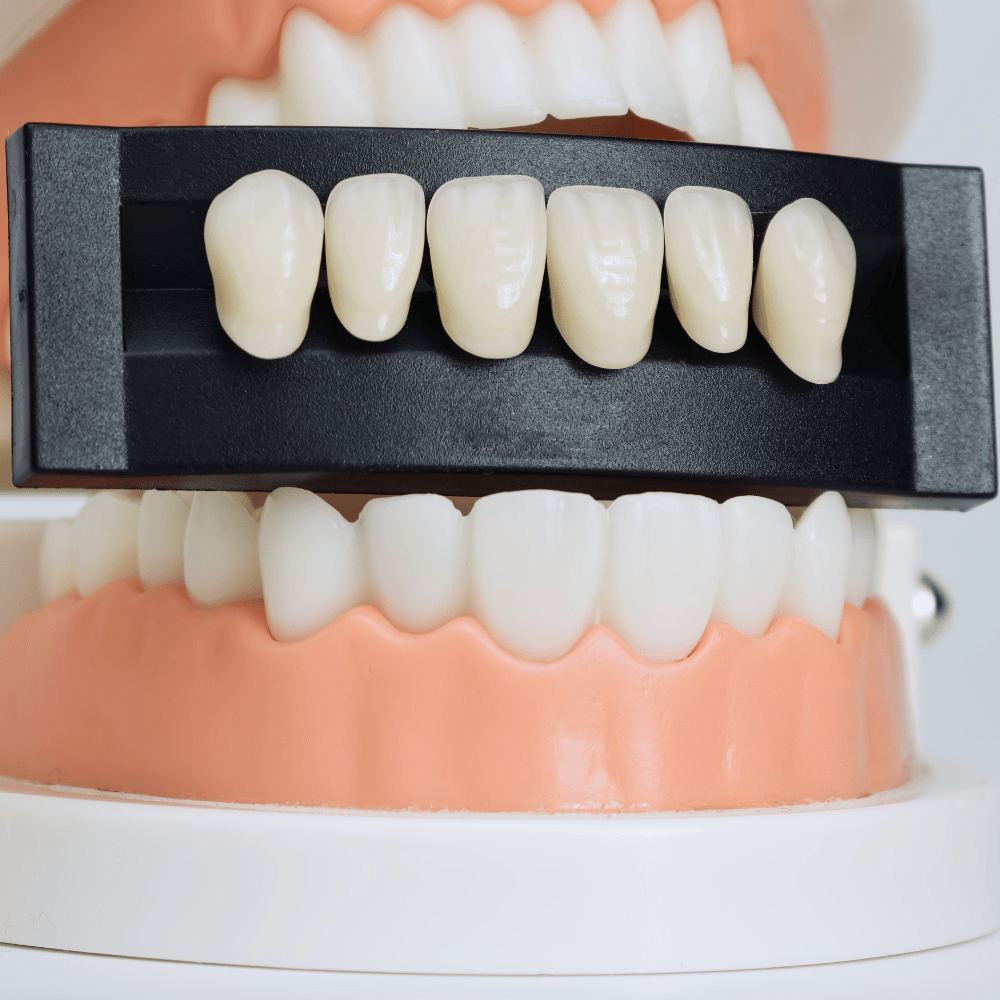 composiet facings Forma injectie techniek