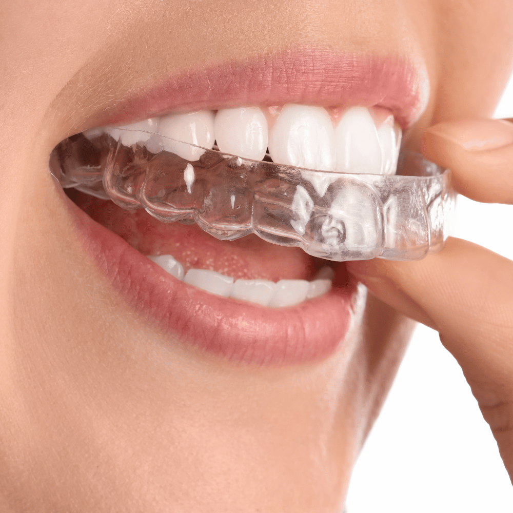 Onzichtbare beugels met aligners